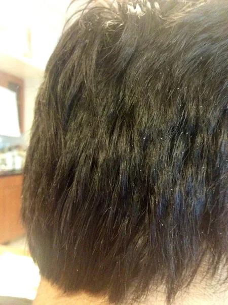 Dandruff Treatment | Dermatologist-Kochi