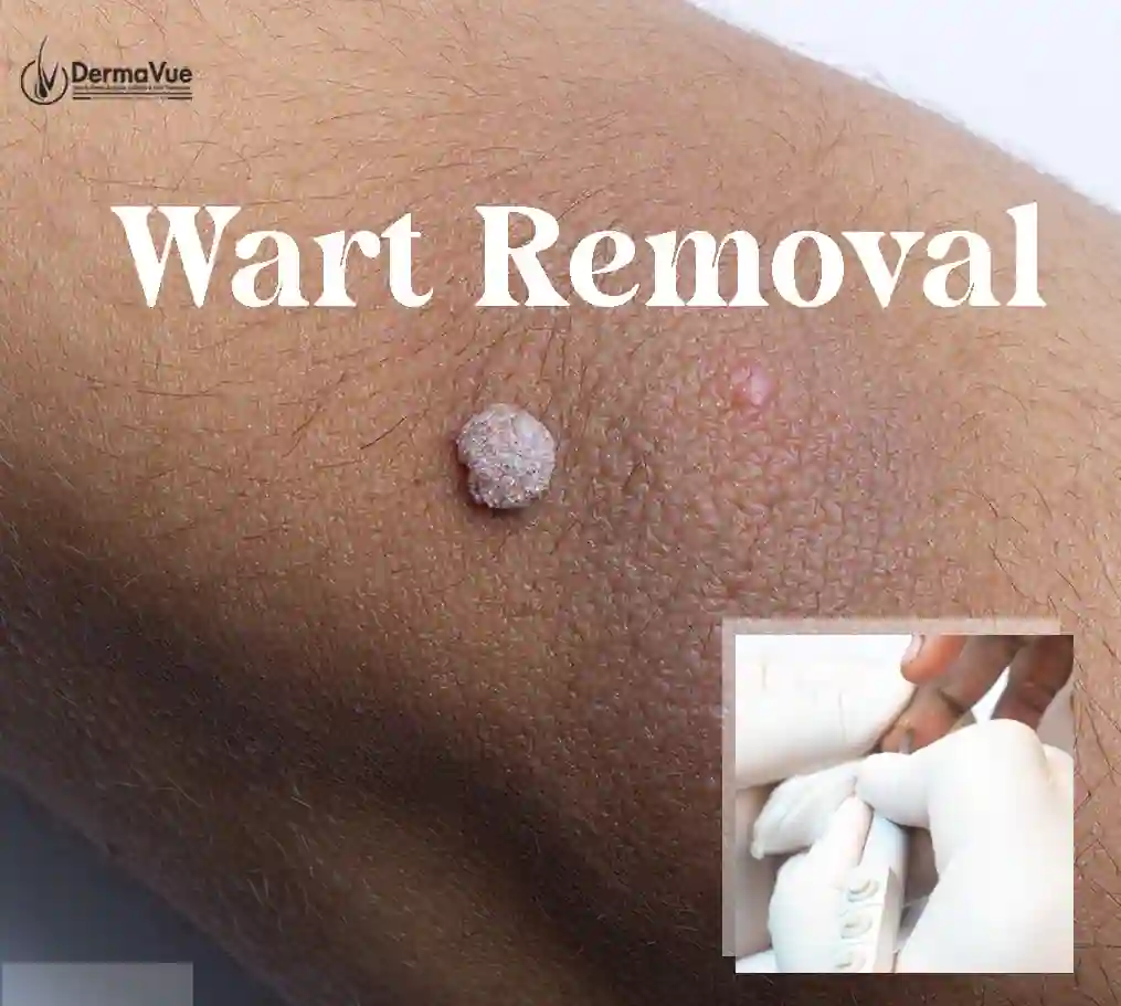 glutathione hypothyroid Wart & Skin Tag Removal in Coimbatore