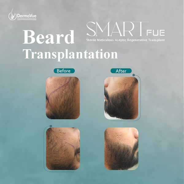 Beard transplant results at DermaVue Kollam