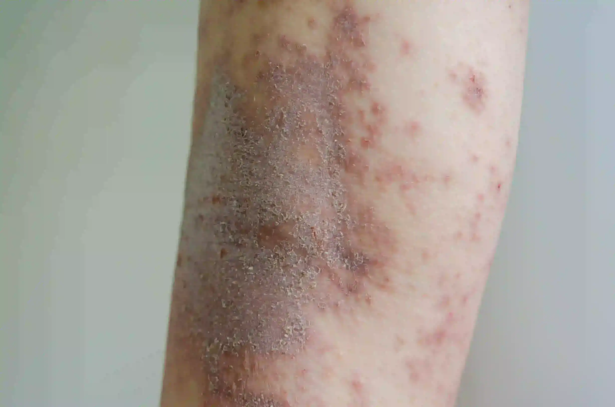 DERMATOLGIST-KOTTAYAM-DERMAVUE_32