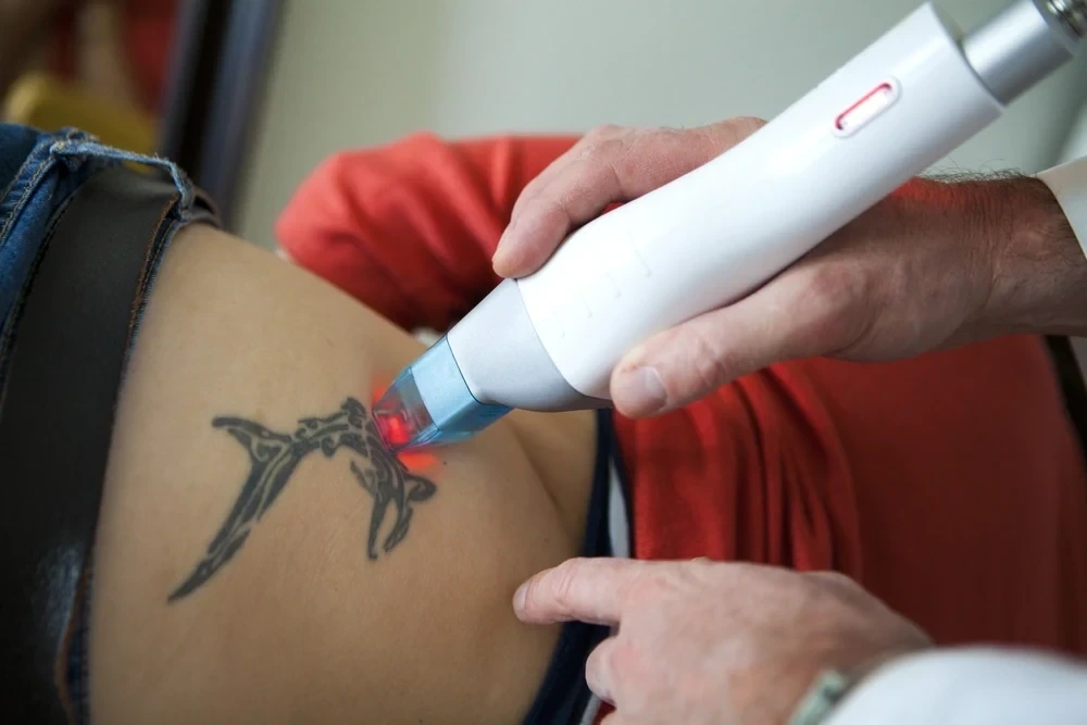DERMATOLGIST-KOTTAYAM-DERMAVUE_74, Tattoo Removal