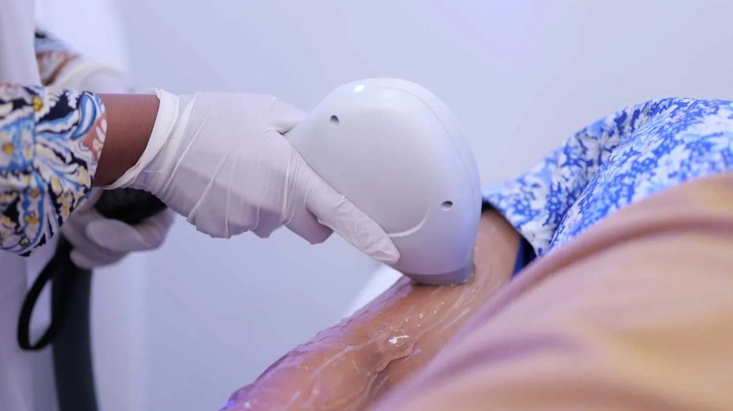 DERMATOLGIST-KOTTAYAM-DERMAVUE_82, Laser Hair Removal