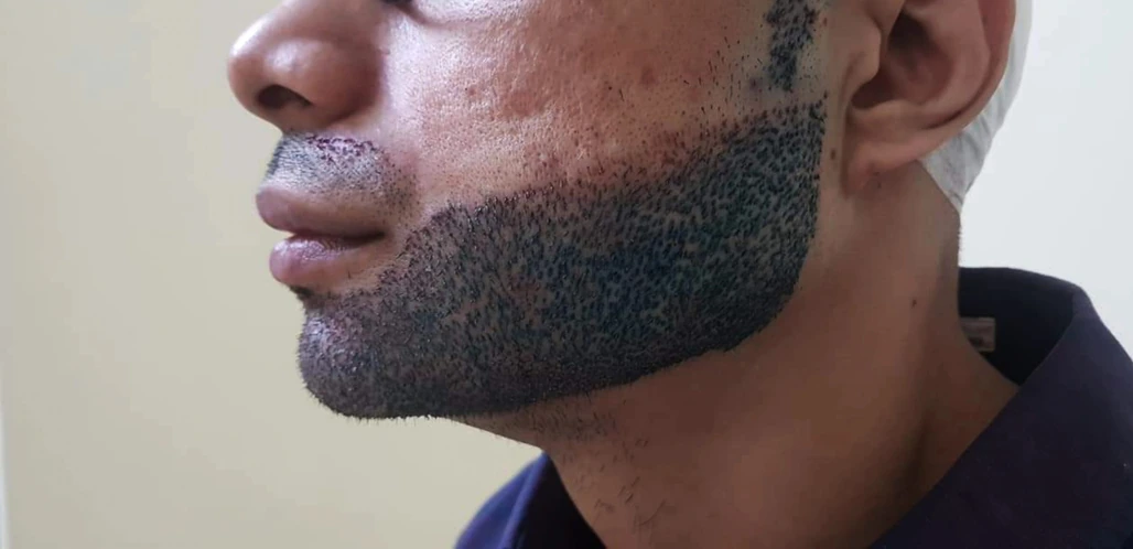 Beard Transplant, DERMATOLGIST-THIRUVANANTHAPURAM-DERMAVUE_34