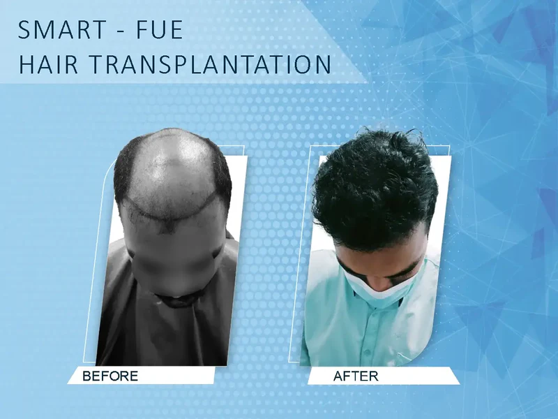 Dermatologist-Thiruvalla-skin-specialist_126, Hair Transplant