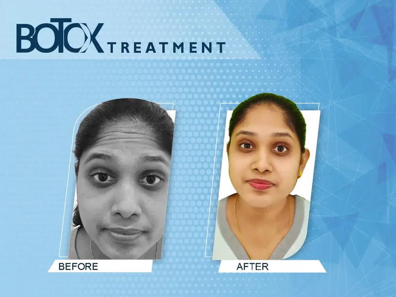 Dermatologist-Thiruvalla-skin-specialist_142, Botox Treatment