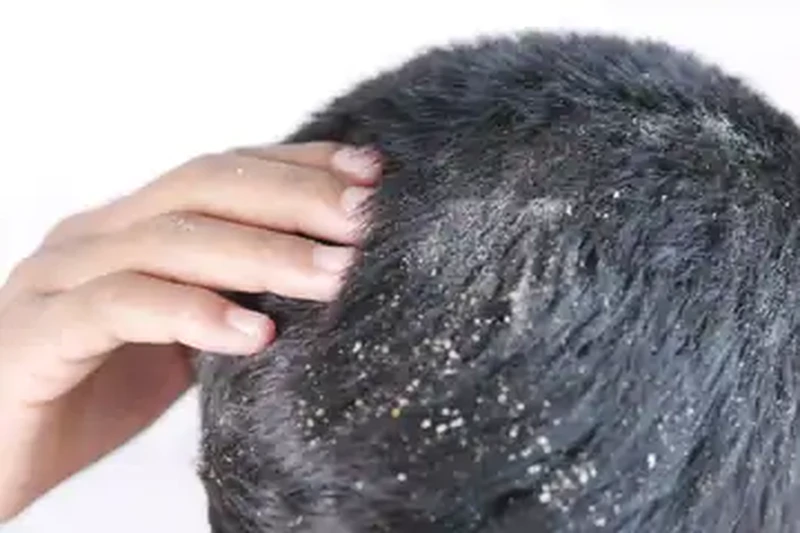Dermatologist-Thiruvalla-skin-specialist_41, Dandruff Treatment