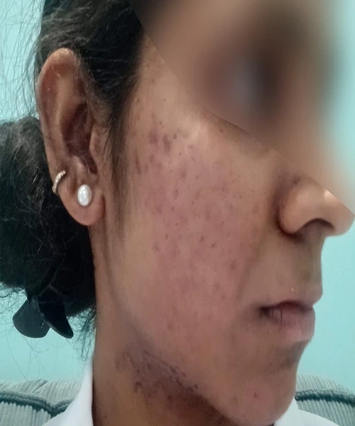 Dermatologist-Thiruvalla-skin-specialist_96, Acne Treatment