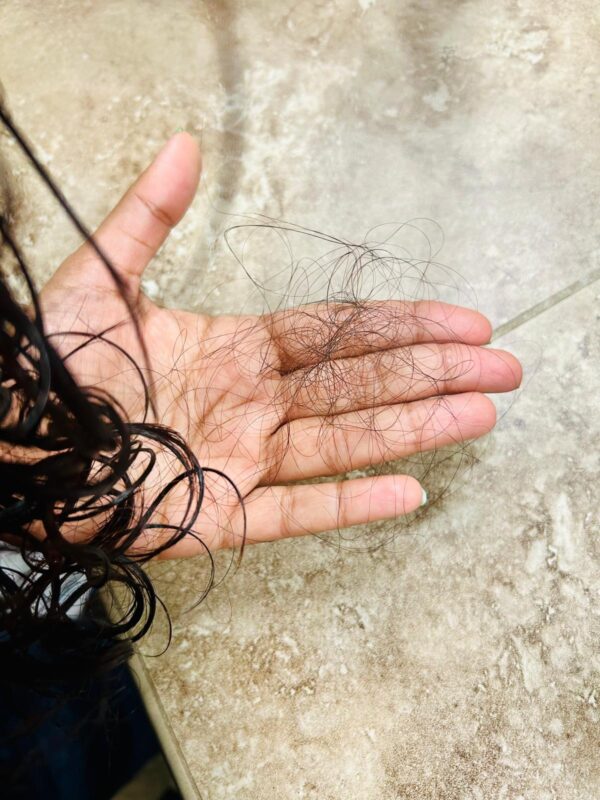 Woman holding clumps of fallen hair after washing - hair fall treatment available at DermaVue Coimbatore