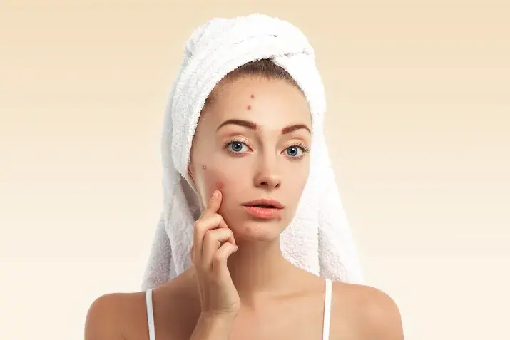 Acne treatment coimbatore