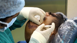 SMART FUE Hair Transplant Kerala DermaVue