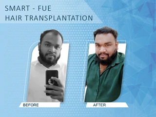 Hairline Reconstruction — 1,800 Grafts DermaVue hair transplant result Kerala