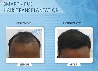 Beard Transplant — 2,400 Grafts DermaVue hair transplant result Kerala