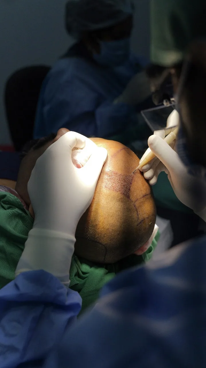 FUE hair transplant procedure at DermaVue