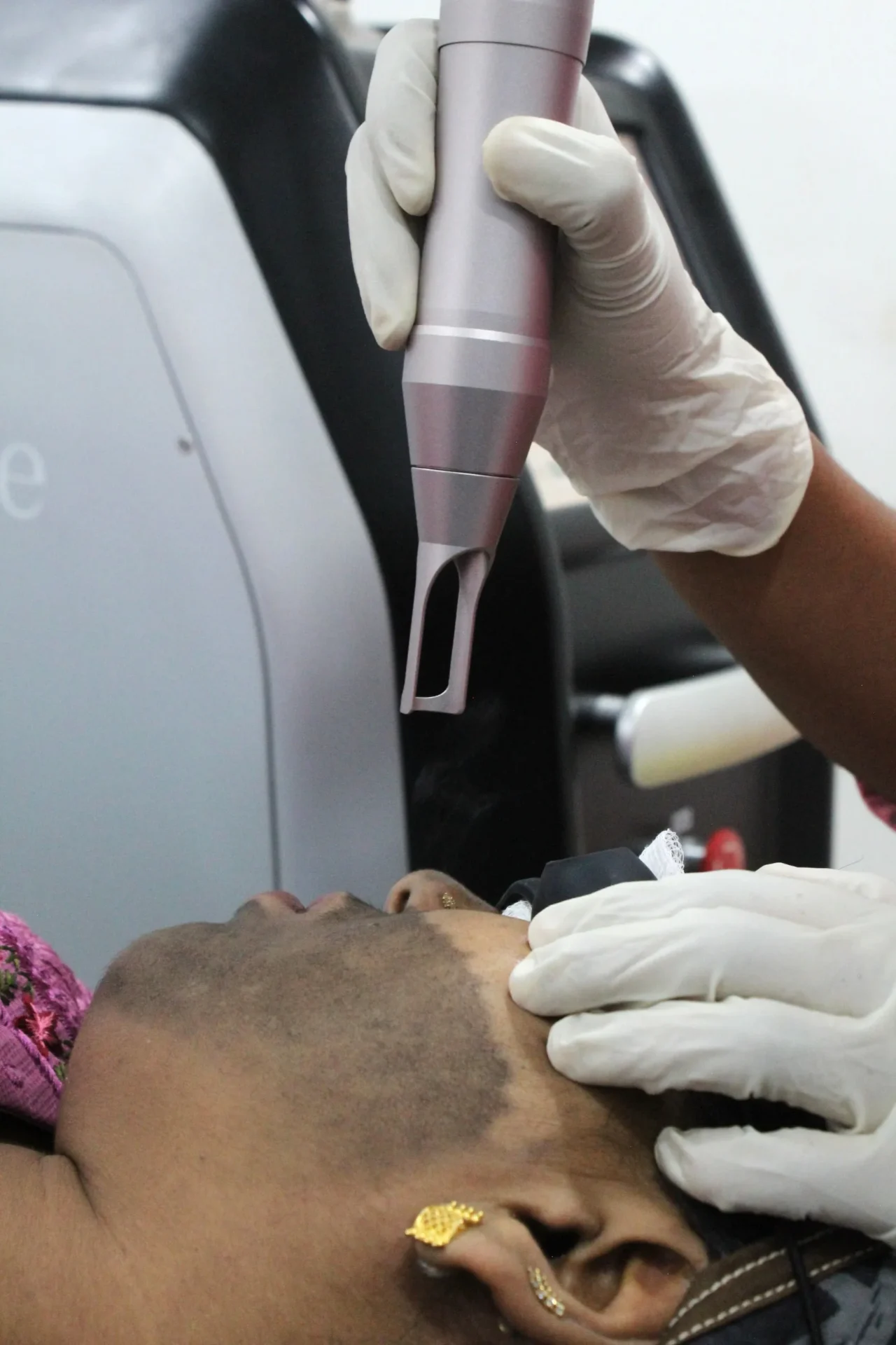 Pigmentation and melasma laser treatment at DermaVue Kottayam