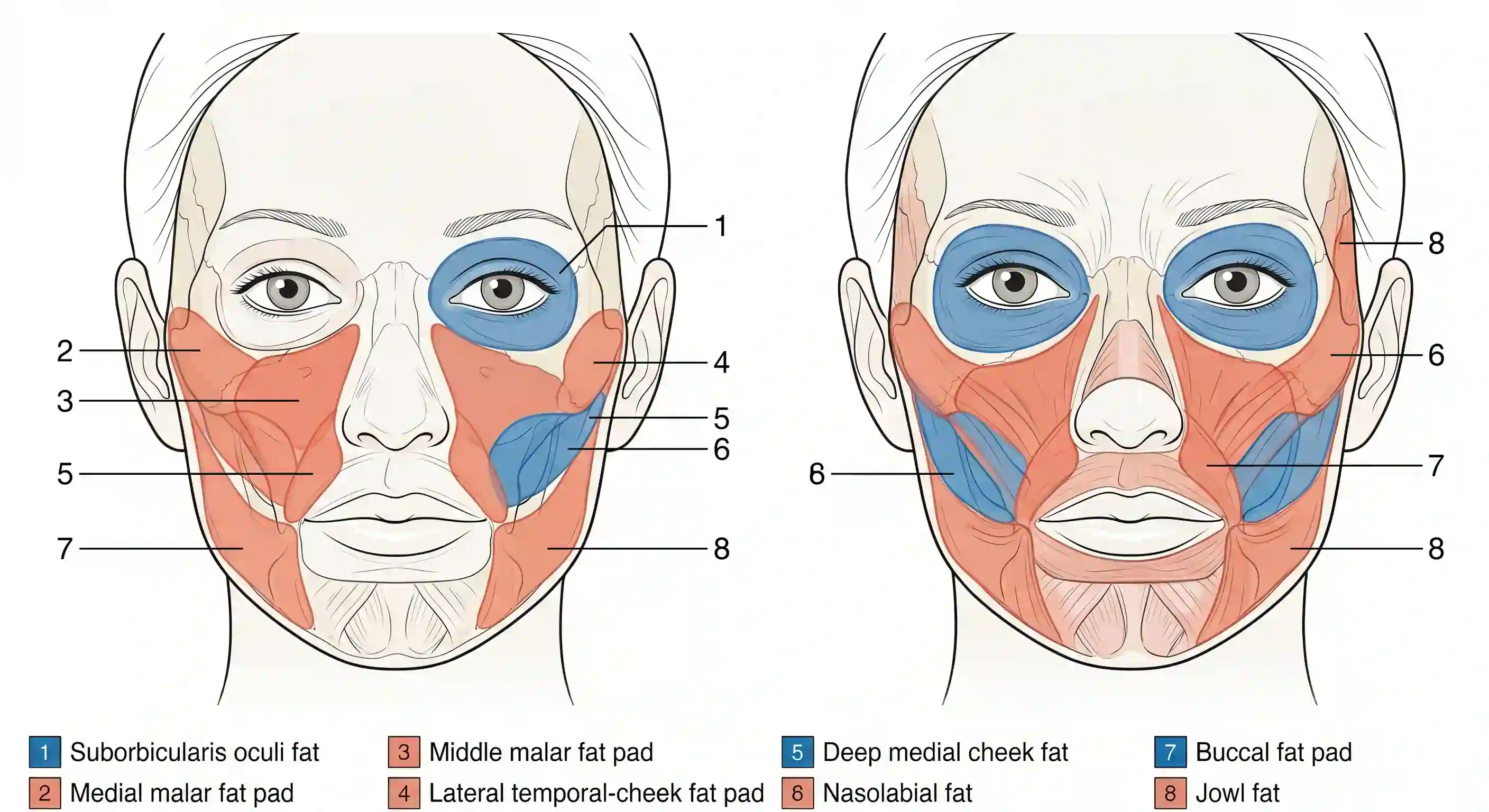 Anatomical illustration of the facial fat compartments. Superficial compartments labelled in coral: medial malar, middle malar, lateral temporal-cheek, nasolabial, jowl, and submental. Deep compartments labelled in blue: suborbicularis oculi fat, buccal fat pad, deep medial cheek, and temporal fat pad. Anatomy adapted from Rohrich and Pessa 2007.