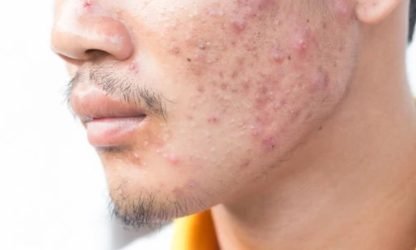 Woman with acne-prone skin receiving treatment at skin care clinic - Kerala