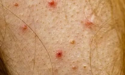 ack peel treatment for truncal acne at best skin clinic in Kerala.