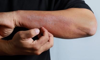 Close-up of discoid eczema rash on skin.