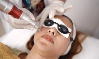 Laser toning treatment for even skin tone at best skin clinic in Kerala.