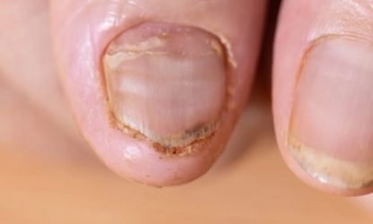 Close-up of nails with various nail problems - Kerala.