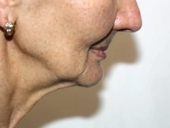 Non-surgical jawline enhancement treatment at best skin clinic in Kerala.