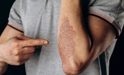 Close-up of skin with psoriasis patches.