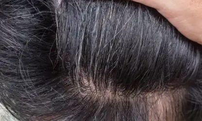 Close-up of scalp with various scalp problems - Kerala.