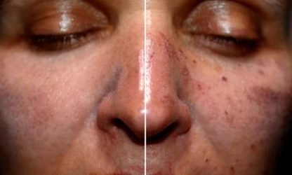 Woman with sun-damaged skin receiving treatment at skin care clinic.