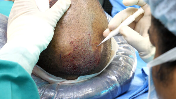 Hair Transplant in Thrissur