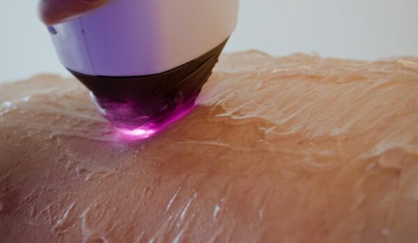 laser-hair-reduction-dermavue-kottayam.jpg