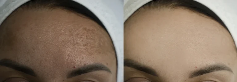 Layered Peels: Advanced Techniques to Enhance Skin Peel Results
